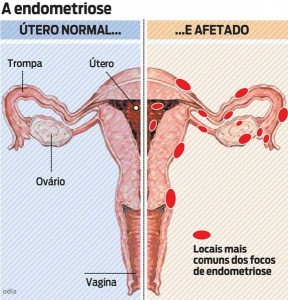endometriose-sintomas