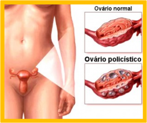 ovario-poli